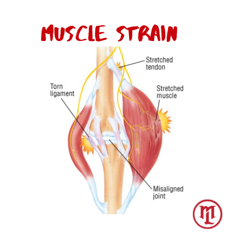 Your Guide To Muscle Strains & How To Treat Them