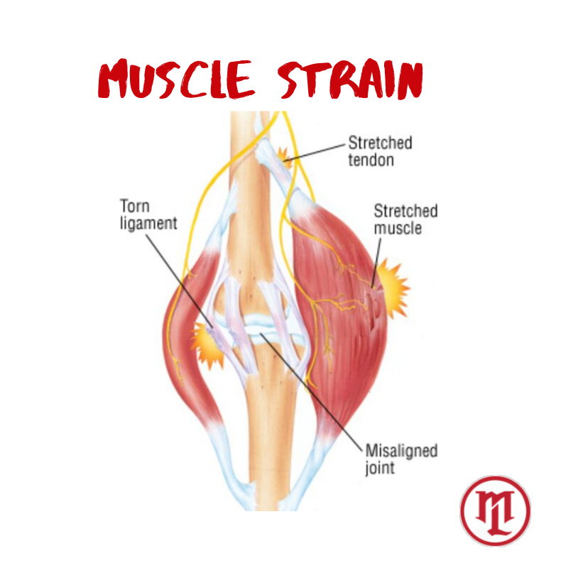 What Does A Muscle Strain Feel Like In The Upper Back